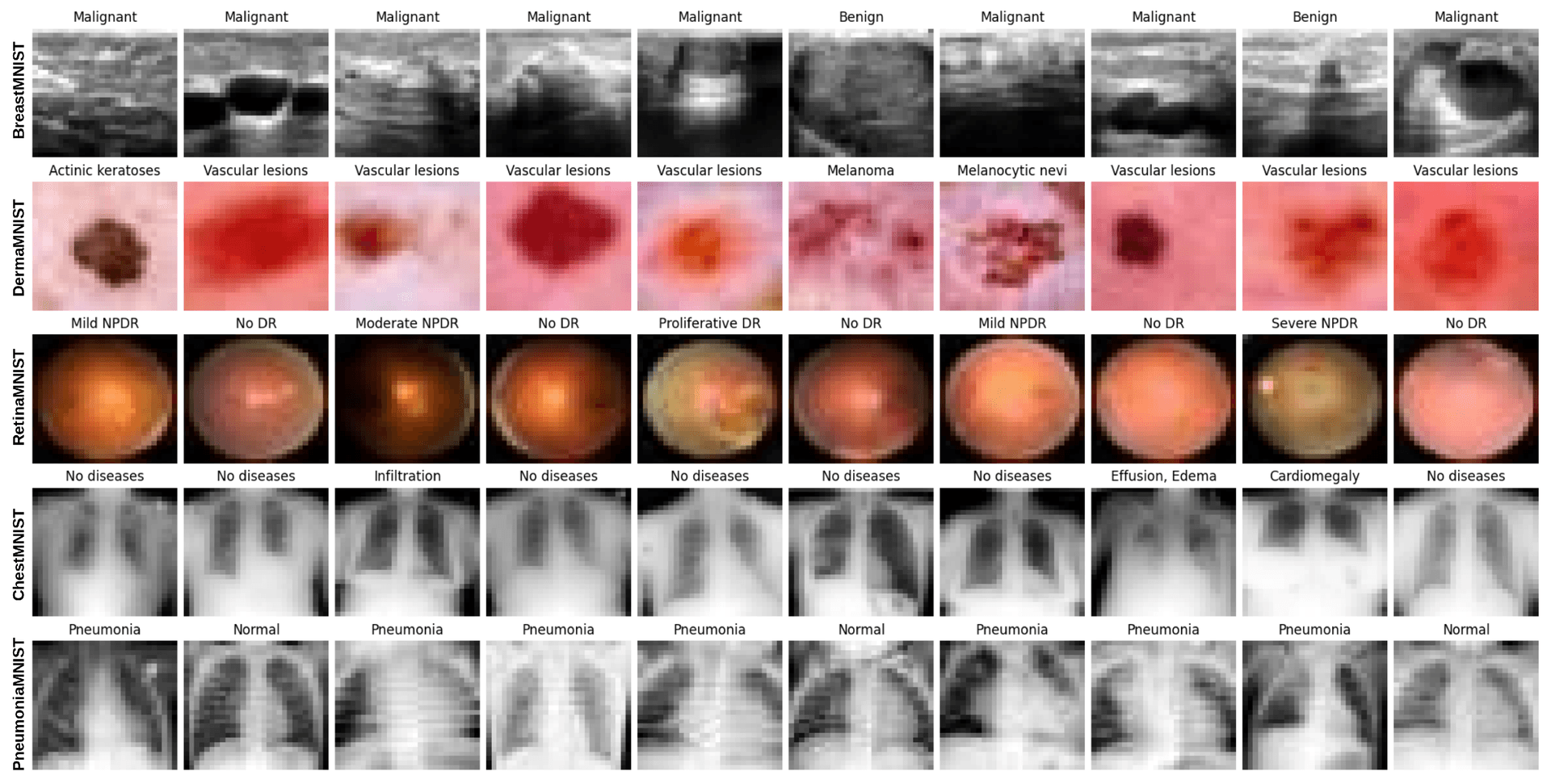 Breast Cancer Predictive Model